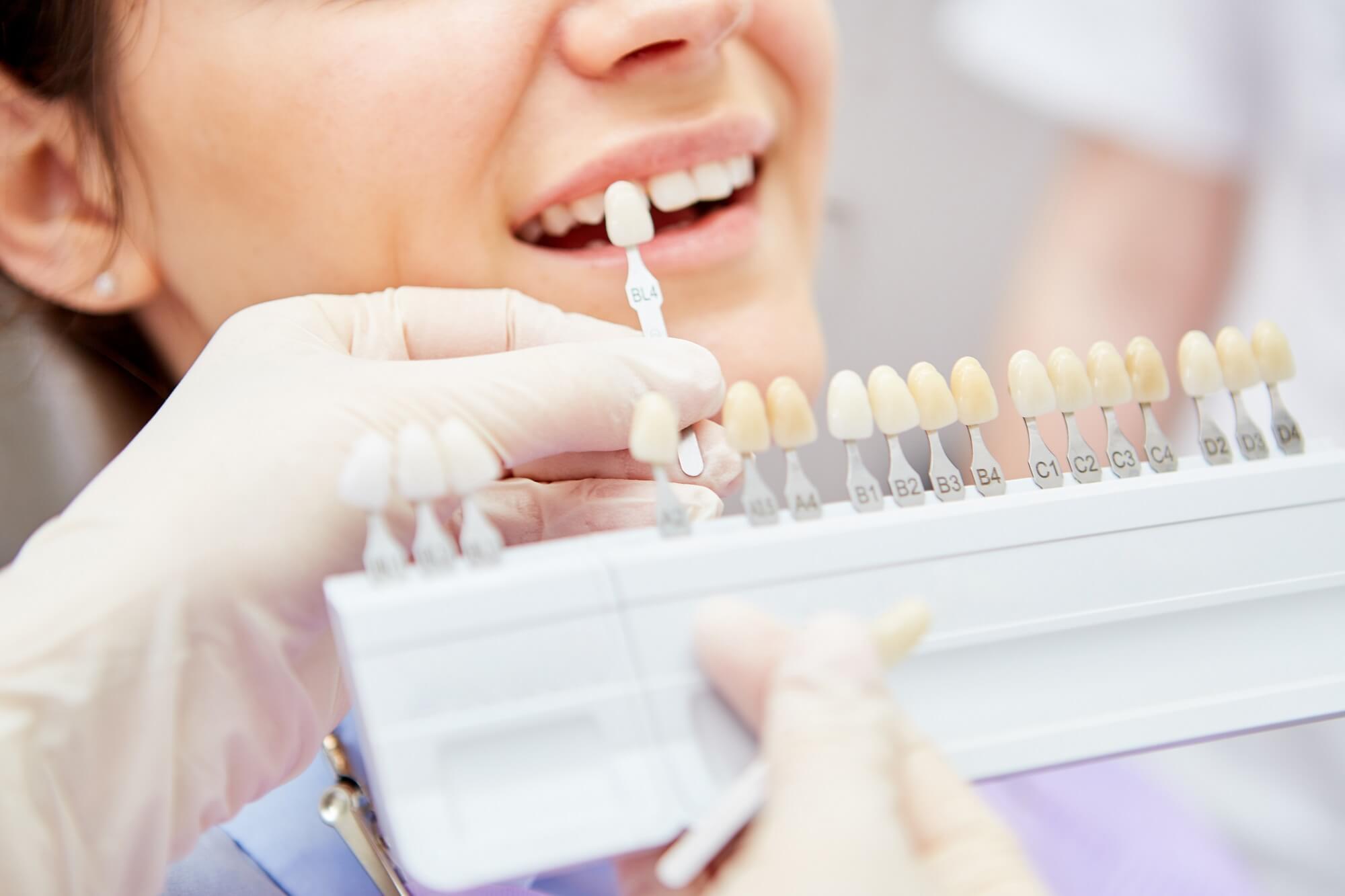 Przebarwienia na zębach – przyczyny, zapobieganie, sposoby usuwania