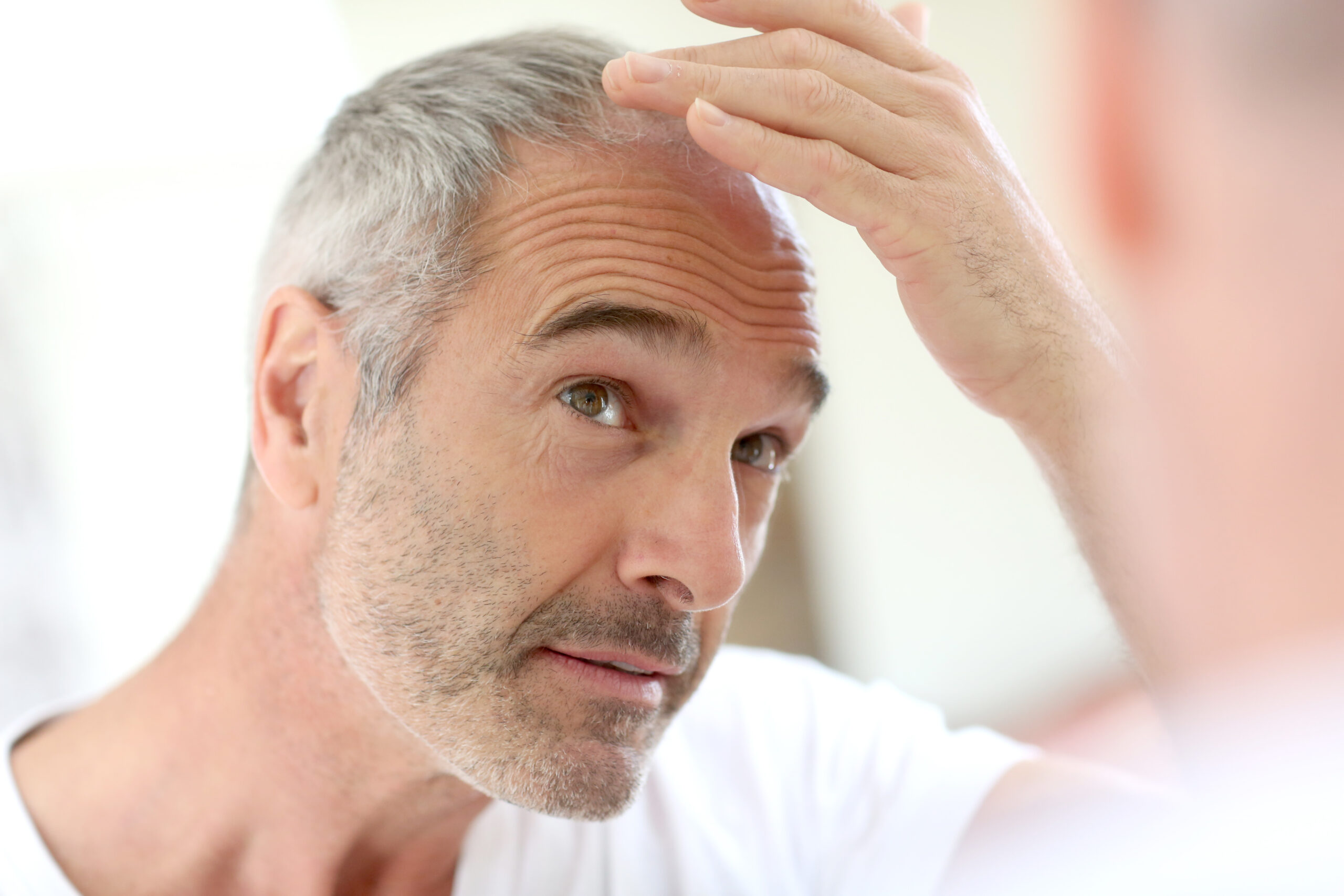 Łysienie androgenowe – przyczyny, objawy łysienia u kobiet i mężczyzn